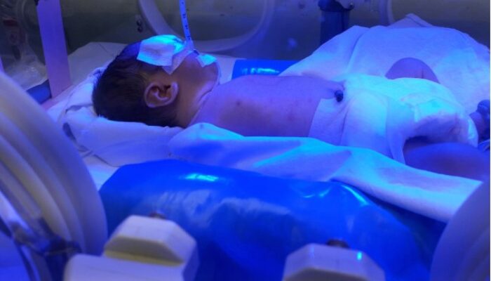 Waspada Bilirubin Tinggi Pada Bayi, Kenali Batas Normalnya